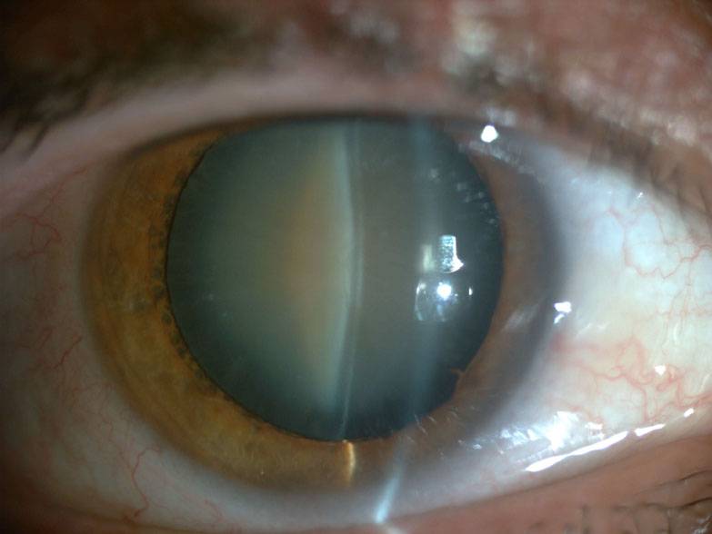 Зрение после замены хрусталика, реабилитация после операции, осложнения