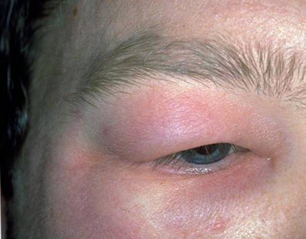 Основные симптомы аллергии на глазах