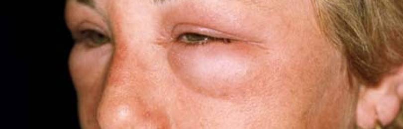 Аллергический отек глаз