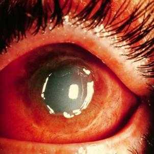 Ожог глаз кварцевой лампой лечение в домашних условиях