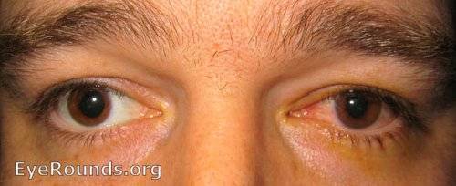 Что делать при возникновении герпетической инфекции возле глаза?