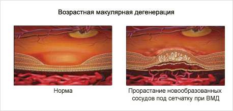 Что такое макула глаза и каким заболеваниям она подвержена oculistic.ru
что такое макула глаза и каким заболеваниям она подвержена