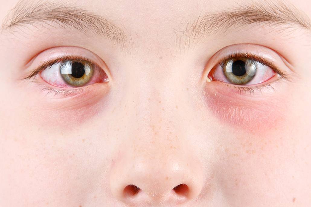 Красные глаза у простудившегося ребенка - простудные заболевания