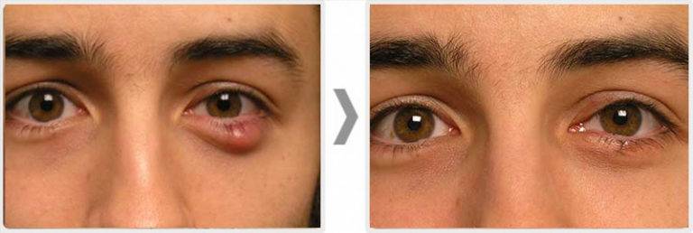 Халязион на глазу: лечение, причины, симптомы, удаление образования, терапия без операции, что это (фото), диагностика, профилатика