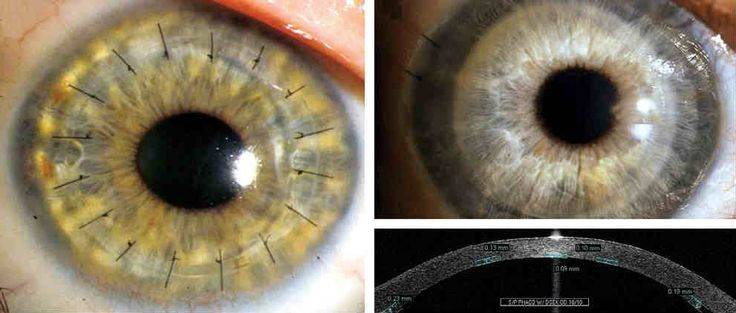 Пересадка роговицы, кератопластика в клинике микрохирургии глаза