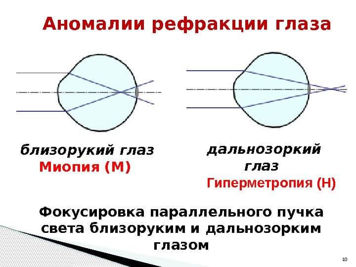 Что такое гиперметропия слабой степени и как её лечить oculistic.ru
что такое гиперметропия слабой степени и как её лечить