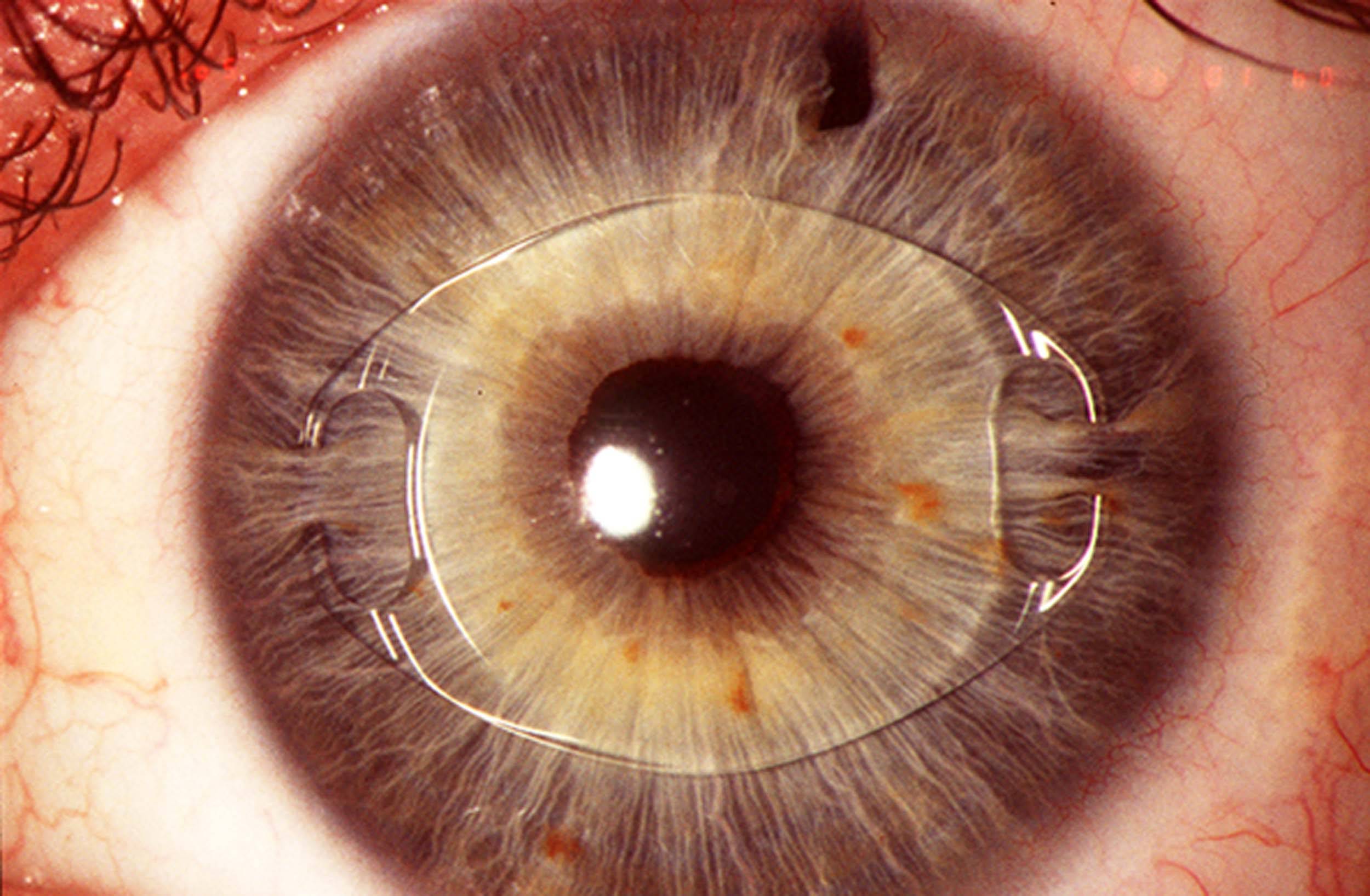 Артифакия глаза - восстановление после операции