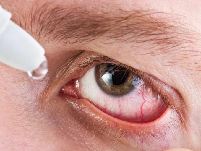 Ушиб глазного яблока: что делать, первая помощь, как лечить в домашних условиях, лечение каплями последствий контузии глаза, удара