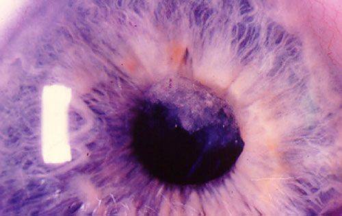 Афакия глаза: что это и как лечить?
