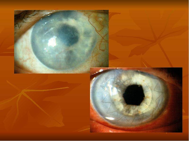Дистрофия роговицы глаза - что это, лечение, причины и симптомы