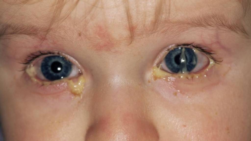 Гноятся глаза у ребенка: что делать, чем лечить гной