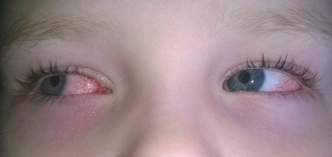 Красные глаза у ребенка - причины и лечение покраснения