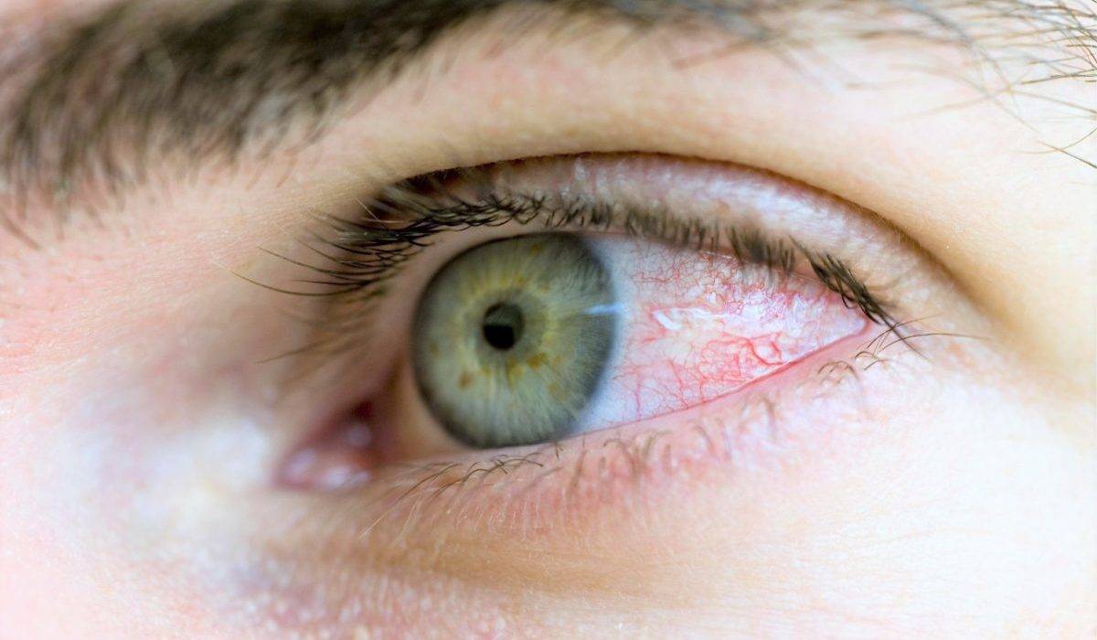 Как убрать красноту глаз в домашних условиях - "здоровое око"
