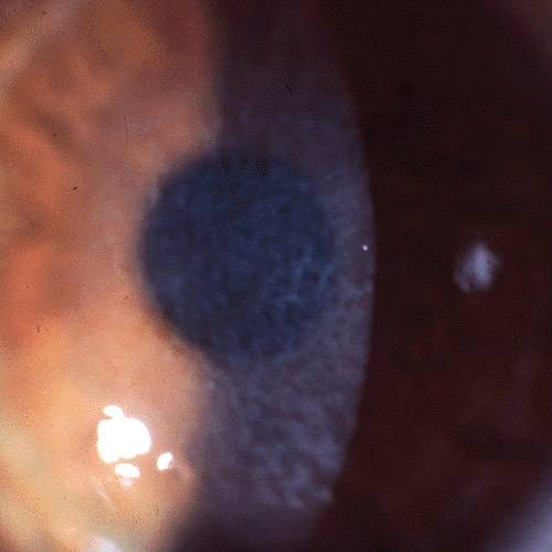 Дистрофия роговицы глаза - что это такое, способы лечения патологии