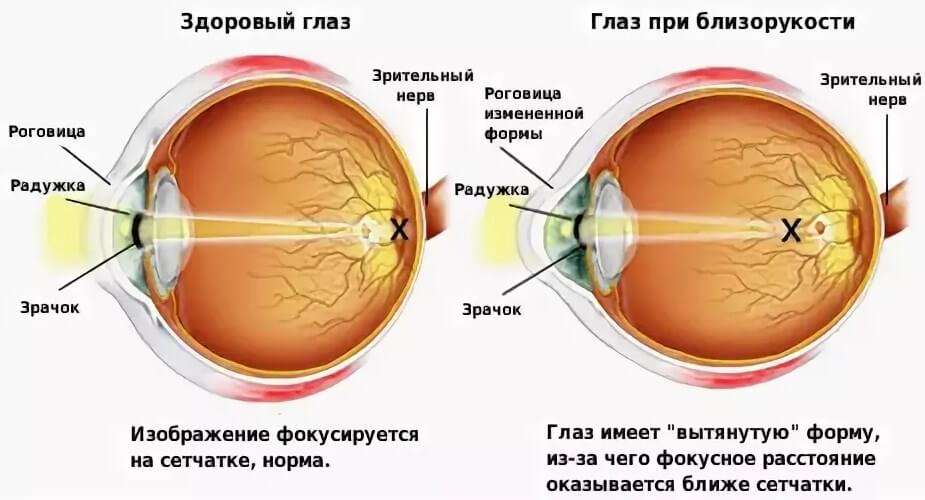 Узнайте как быстро восстановить зрение при близорукости
