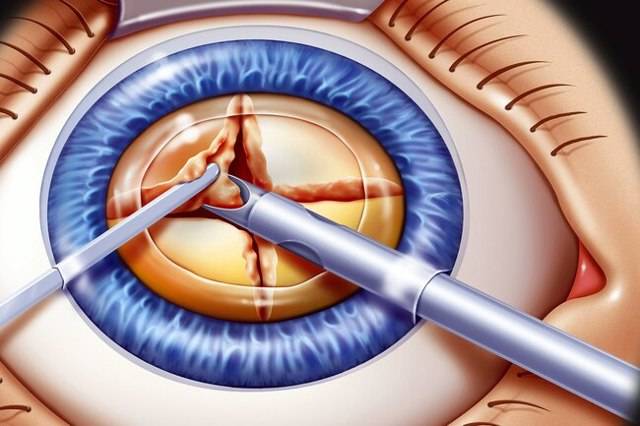 Факоэмульсификация катаракты: показания, ход и виды операции, реабилитация