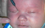 Дакриоцистит у новорожденных: симптомы и признаки заболевания, способы лечения патологии у детей