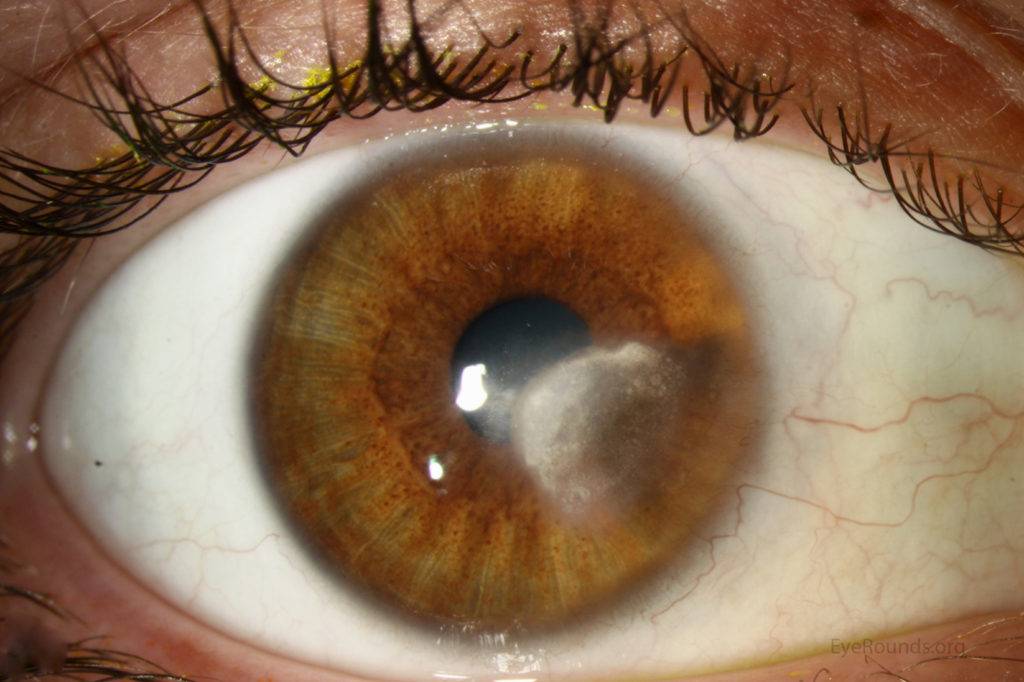 Повреждение роговицы глаза - причины, симптомы и лечение