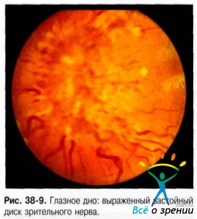 Что такое застойный диск зрительного нерва