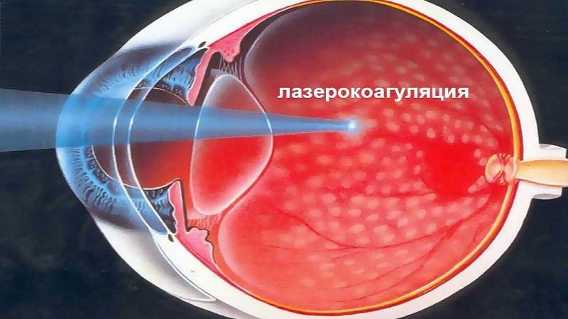 Ограничения после лазерной коагуляции сетчатки глаза, осложнения