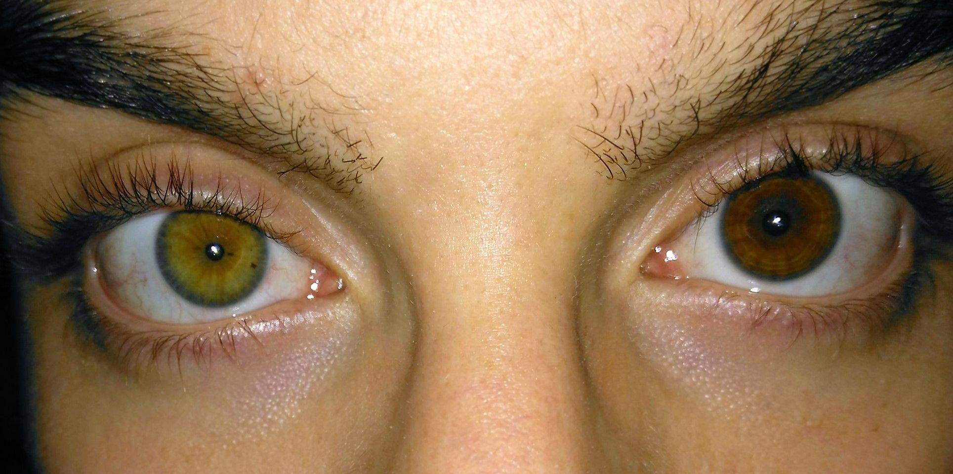 Люди с разным цветом и размером глаз: болезнь или норма