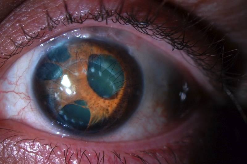 Зрачок - строение, диагностика заболеваний - "здоровое око"