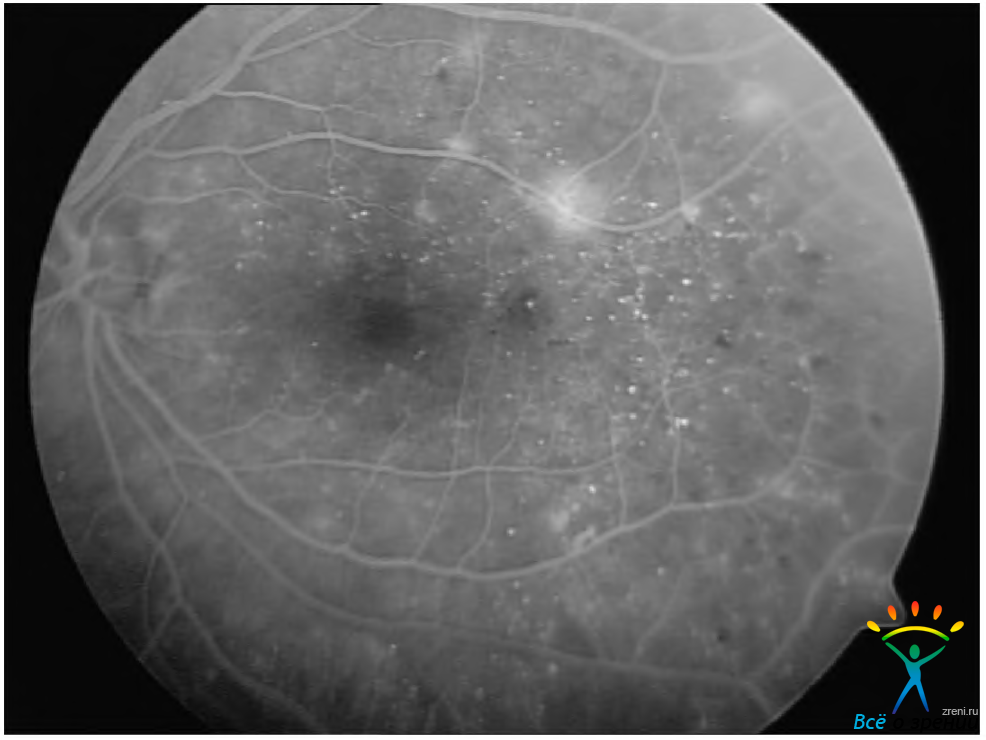 Флуоресцентная ангиография (фаг) сетчатки глаза - показания, противопоказния, методика исследования