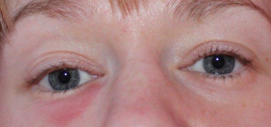 У ребенка отек глаз: лечение аллергии, как быстро снять опухоль и покраснение