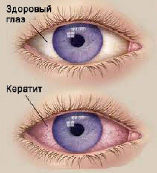 Кератит глаза - виды, причины и симптомы, методы лечения