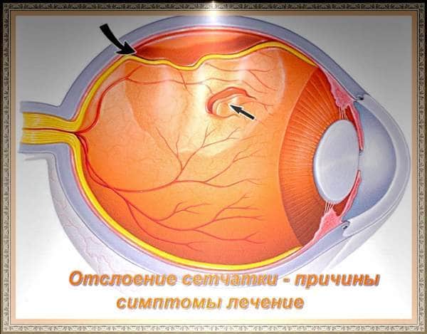 Заболевания сетчатки глаза