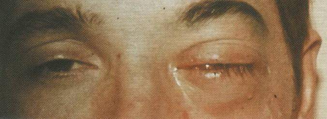 Контузия (ушиб) глаза: симптомы и лечение, степени и негативные последствия - moscoweyes.ru - сайт офтальмологического центра "мгк-диагностик"