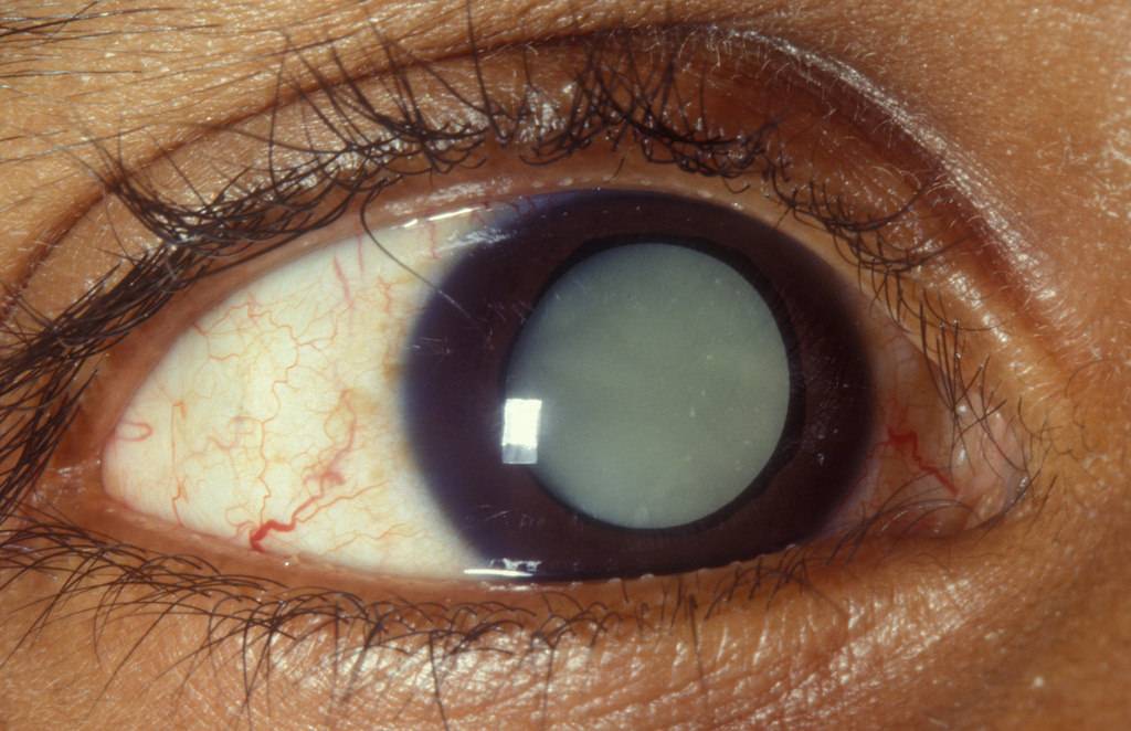 Глаукома ошибочный диагноз - вылечимглаукому
