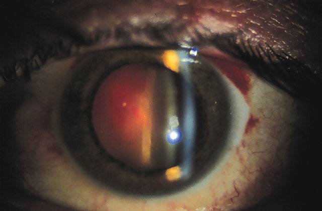 Что такое гемофтальм глаза: причины и лечение oculistic.ru
что такое гемофтальм глаза: причины и лечение
