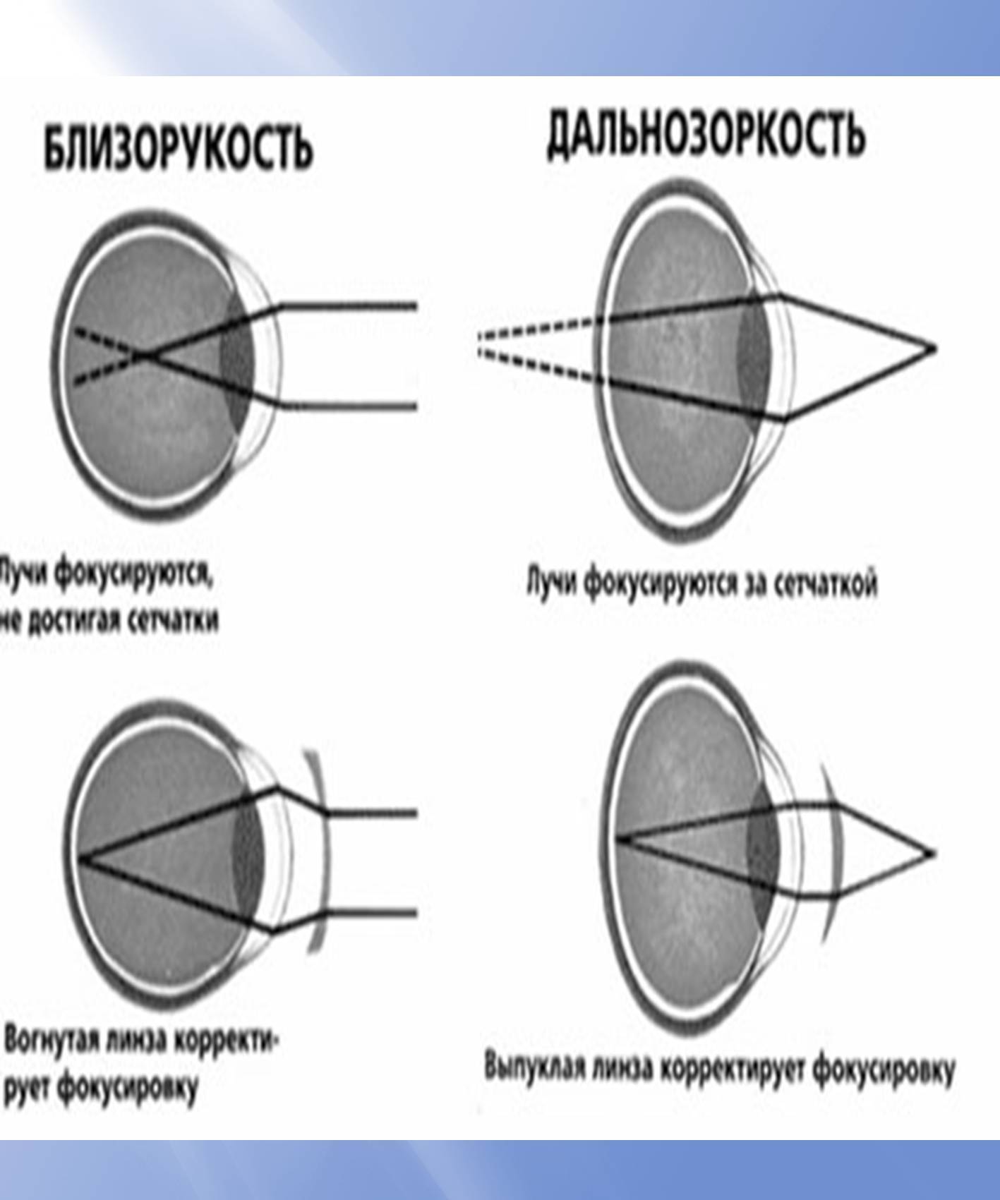 Очки при дальнозоркости: какие нужны и как выбрать, правила очковой коррекции при гиперметропии, нужно ли носить постоянно, виды оптики (пресбиопические, для чтения)