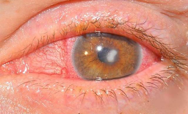 Фиброз стекловидного тела глаза что это такое