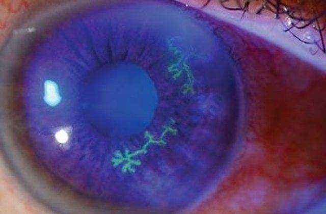 Офтальмогерпес и герпетический кератит: причины возникновения глазного герпеса, симптомы, диагностика и лечение + фото