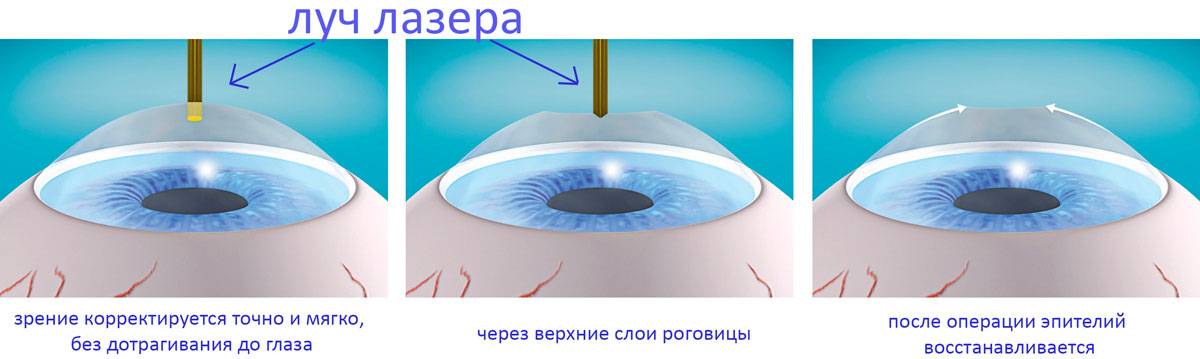 Перечень ограничений после лазерной коррекции зрения