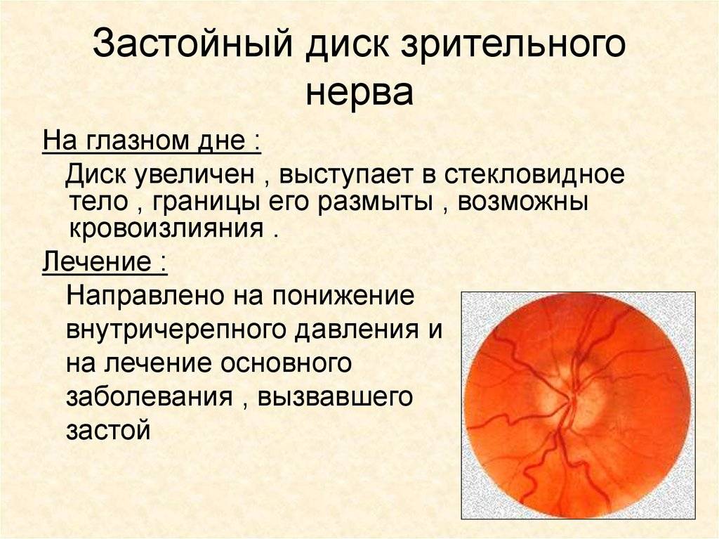 Отёк диска зрительного нерва: причины, симптомы, лечение oculistic.ru
отёк диска зрительного нерва: причины, симптомы, лечение