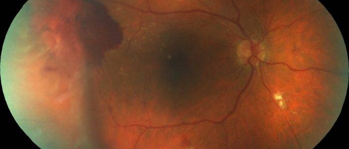 Страшные последствия для зрения! фоновая ретинопатия и ретинальные сосудистые изменения: что это такое