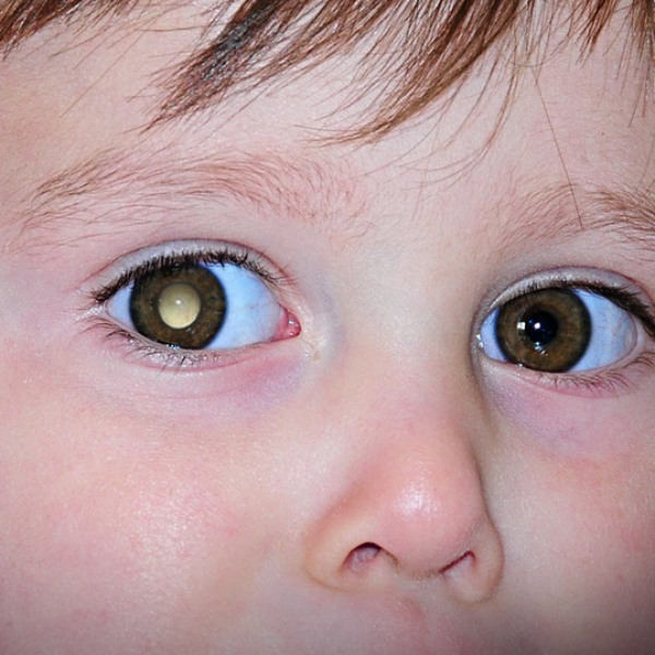 Рак глаза у детей - фото, симптомы, лечение, последствия