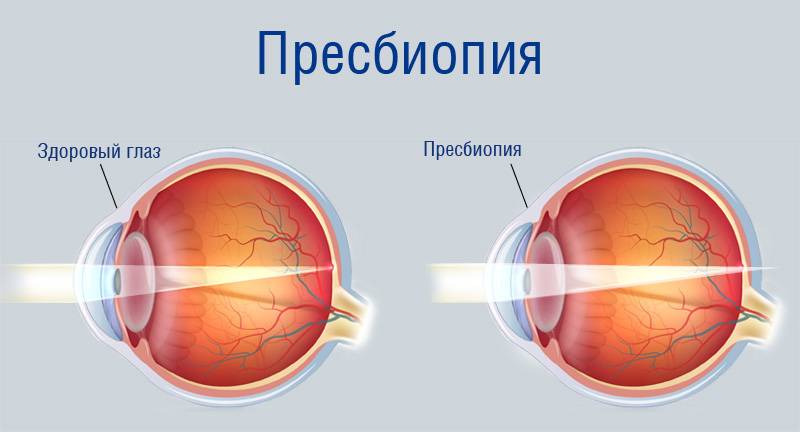 Заболевание глаз, которое встречается у людей чаще всего - близорукость и все о ней