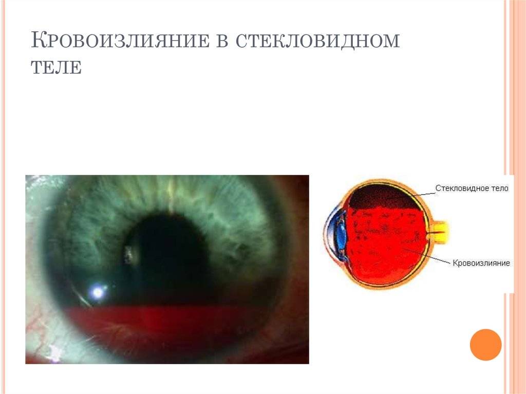 Кровоизлияние в стекловидное. Гемофтальм стекловидного тела. Кровоизлияние в стекловидное тело. Контузионный гемофтальм. Субтотальный гемофтальм.