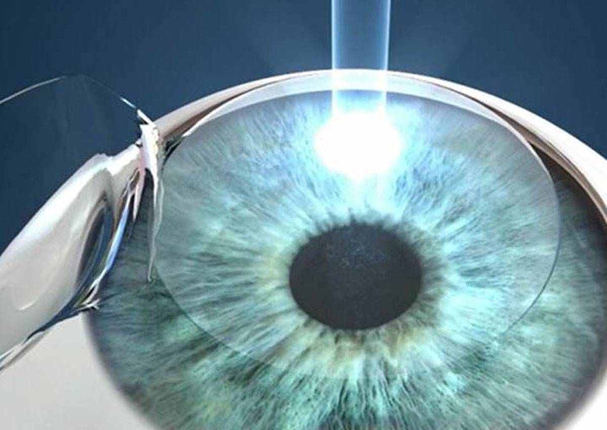 Восстановление зрения после лазерной коррекции: сроки, основные правила, рекомендации