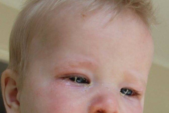 Закисает глаз у новорожденного: причины и решение