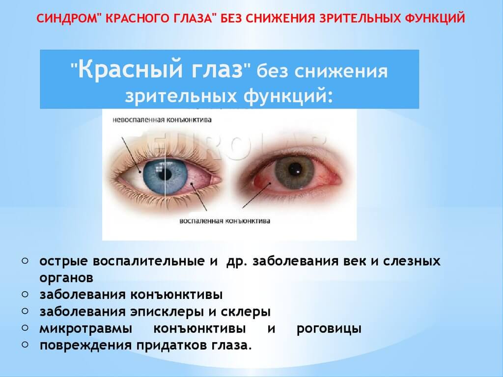 Синдром сухого глаза (ксерофтальмия): причины, симптомы, лечение и капли