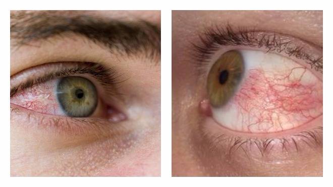 Почему краснеют глаза от линз:причины, симптомы - "здоровое око"