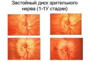 Причины воспаления зрительного нерва