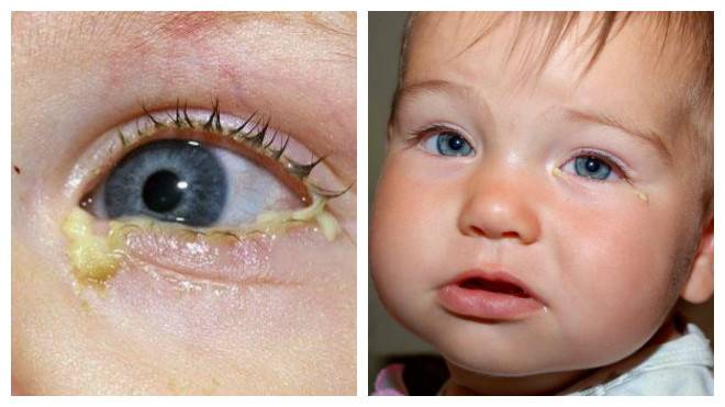 Гной в глазах у ребенка: причины, принцип лечения без вреда