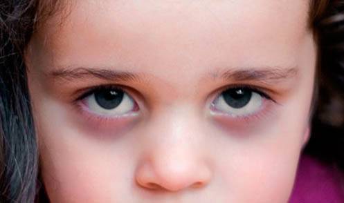 Синяки под глазами у ребенка. причины синяков под глазами. как устранить?