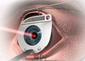 Консультация офтальмолога: противопоказания к лазерной коррекции зрения
